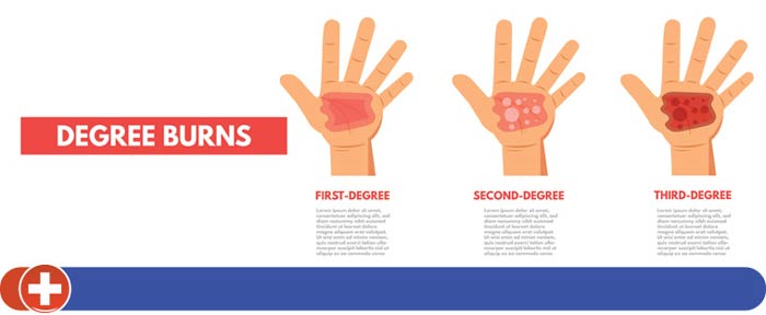 Urgent Care for Burns Near Me Cincinnati OH Urgent Care for Burns Near Me Cincinnati OH