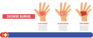Urgent Care for Burns Near Me Cincinnati OH Urgent Care for Burns Near Me Cincinnati OH