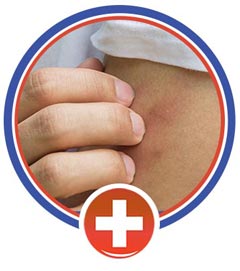Insect and Animal Bites Treatment Near Me in Cincinnati, OH