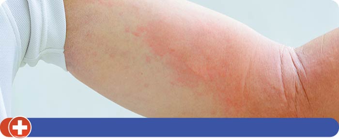 Allergic Reactions Treatment Near Me in Cincinnati, OH Allergic Reactions Treatment Near Me in Cincinnati, OH