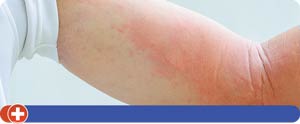 Allergic Reactions Treatment Near Me in Cincinnati, OH Allergic Reactions Treatment Near Me in Cincinnati, OH