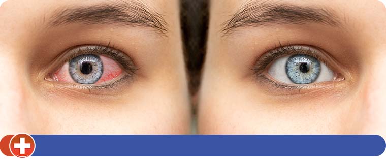Pink Eye Treatment Specialist Near Me in Cincinnati, OH Pink Eye Treatment Specialist Near Me in Cincinnati, OH