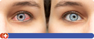 Pink Eye Treatment Specialist Near Me in Cincinnati, OH Pink Eye Treatment Specialist Near Me in Cincinnati, OH