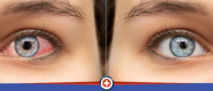 Pink Eye Treatment Specialist Near Me Serving Eastgate Cincinnati, OH Pink Eye Treatment Specialist Near Me Serving Eastgate Cincinnati, OH