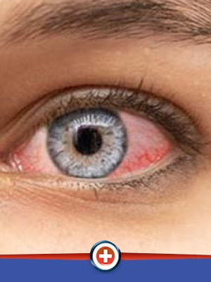 Pink Eye Treatment Specialist Near Me Serving Eastgate Cincinnati, OH