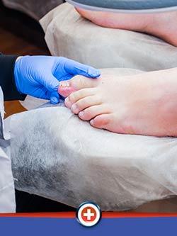 Ingrown Toenail Removal Near Me in Cincinnati, OH